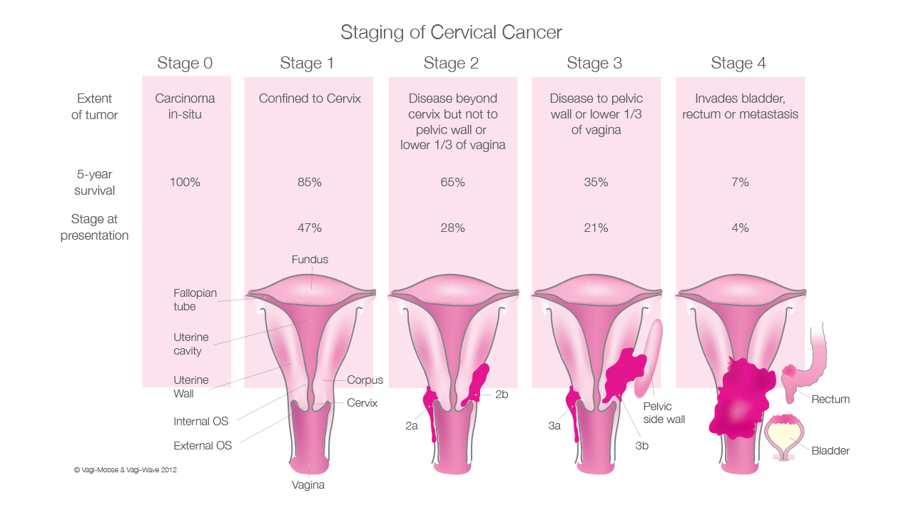 cervical cancer symptoms 